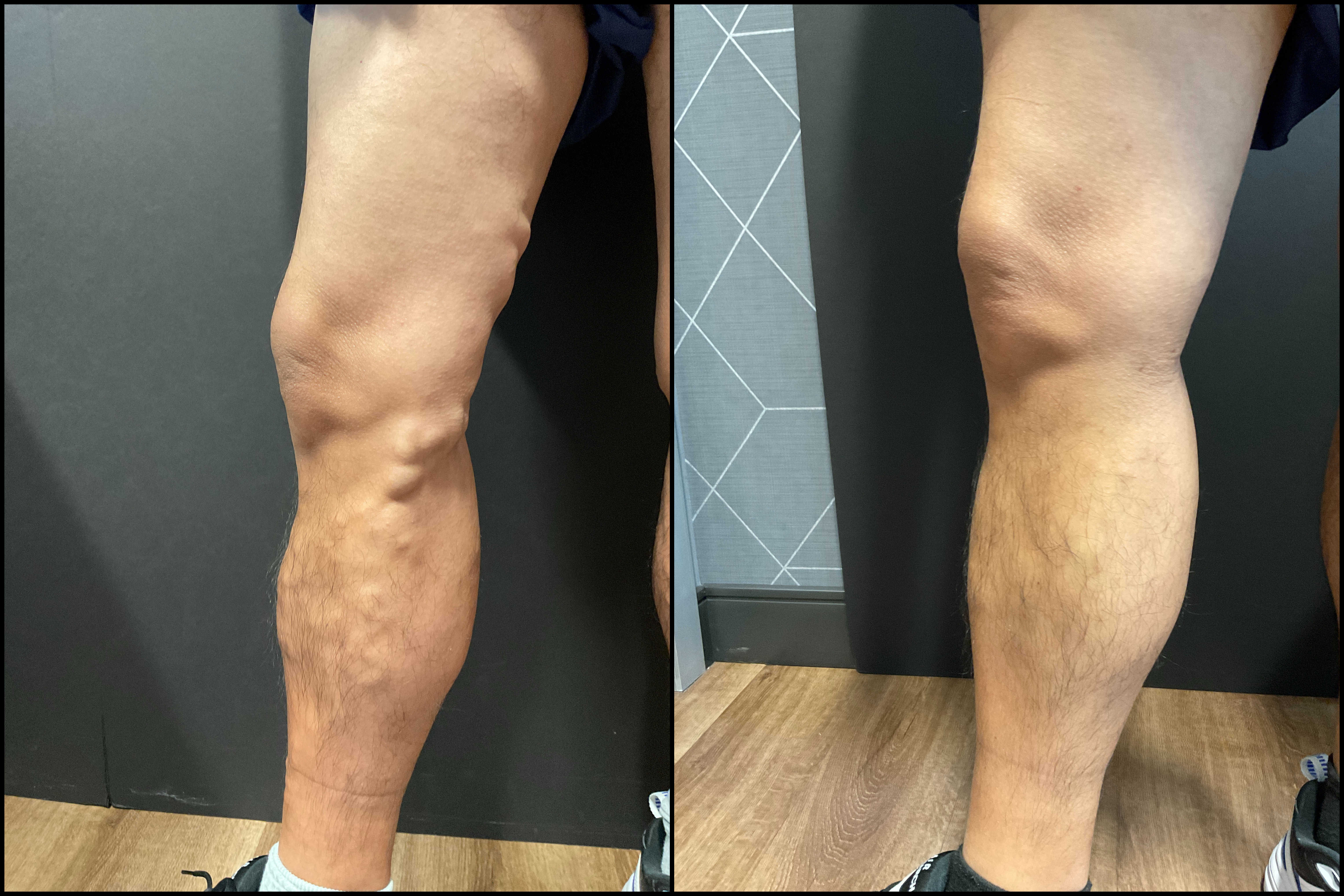 vein treatment before and after image