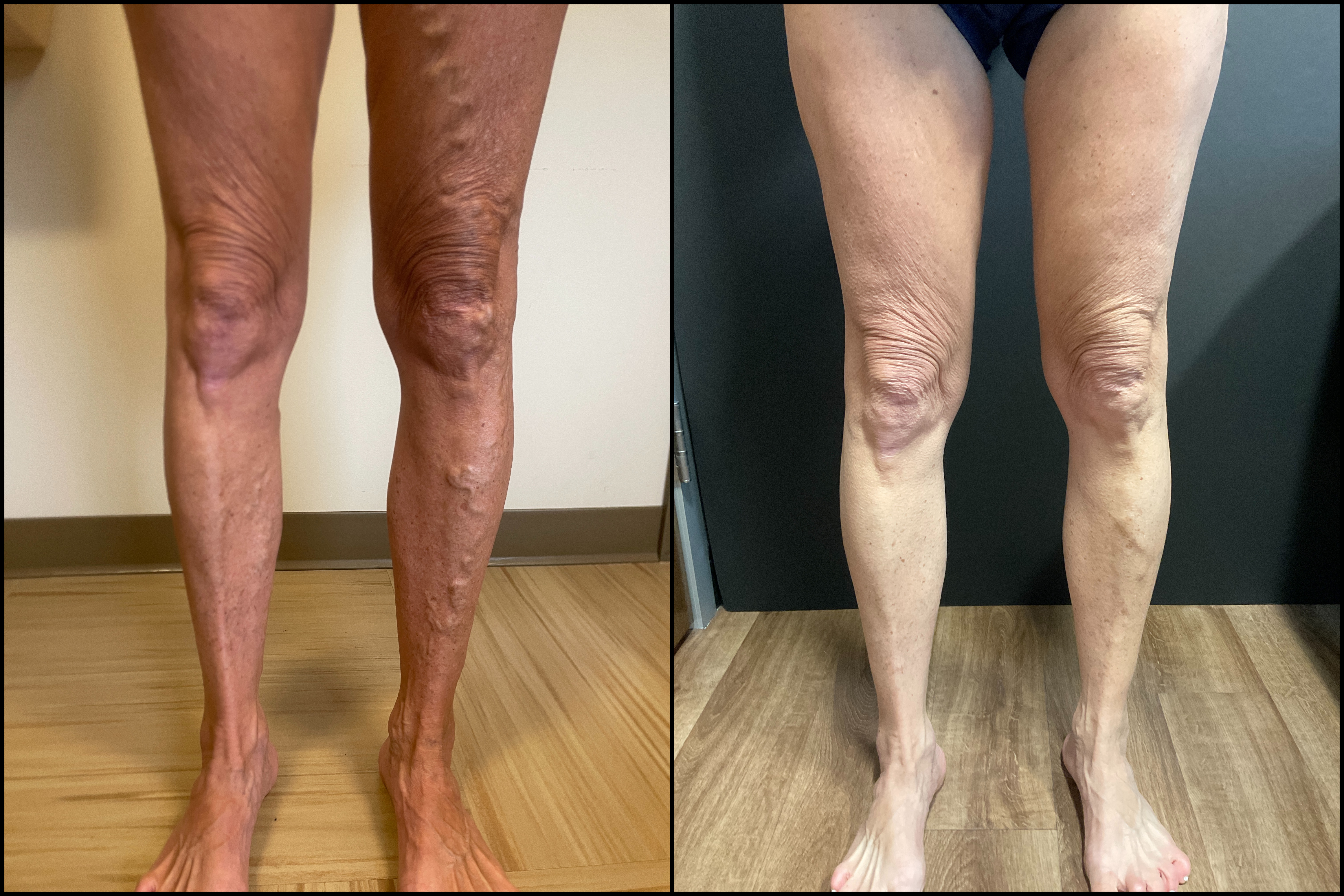 vein treatment before and after image