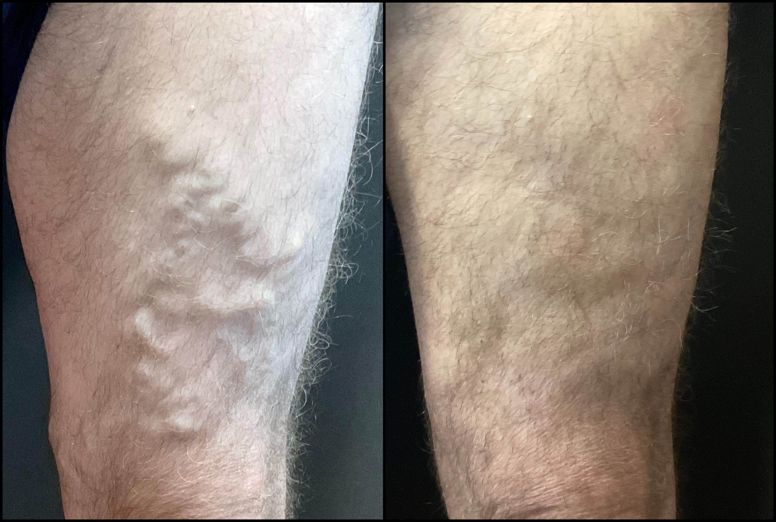 vein treatment before and after image