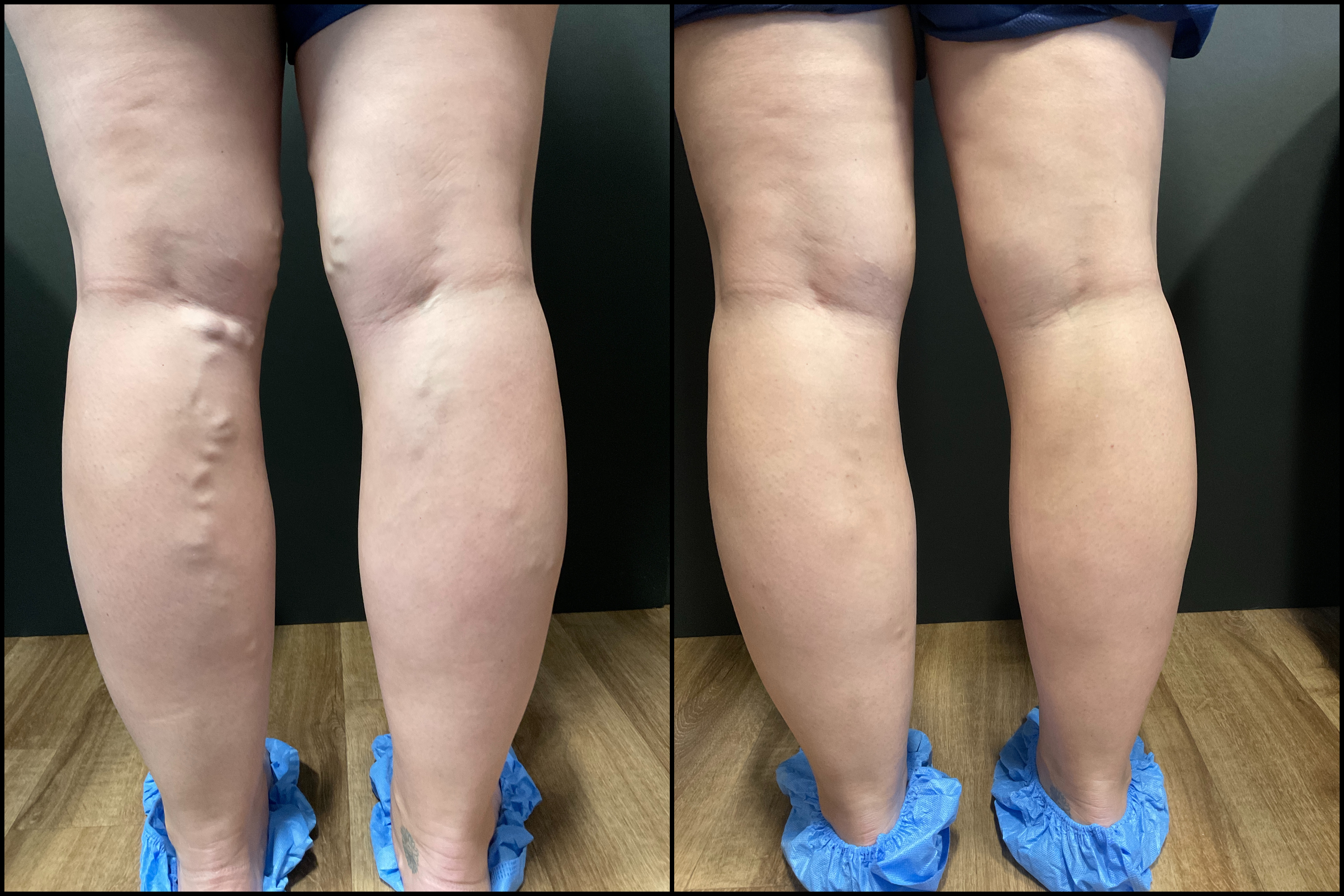 vein treatment before and after image