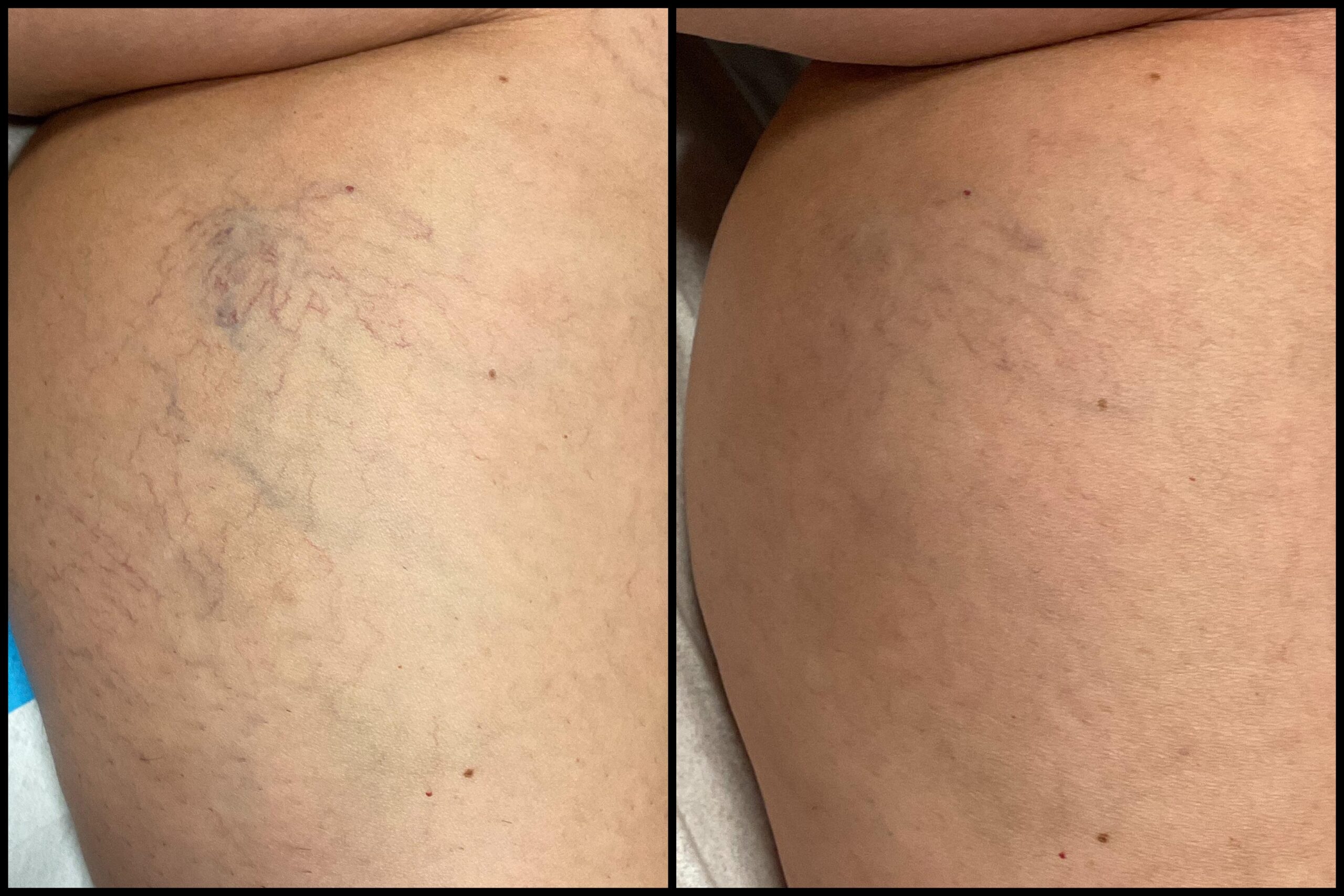 vein treatment before and after image