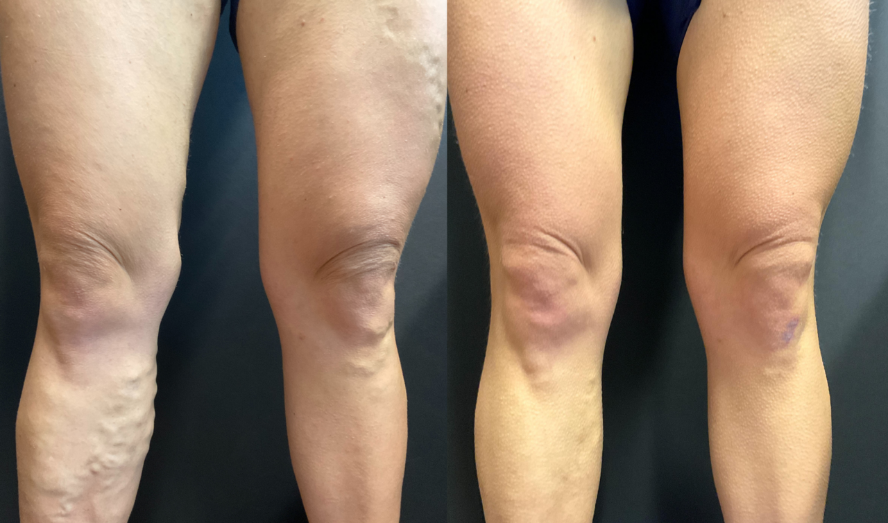 vein treatment before and after image