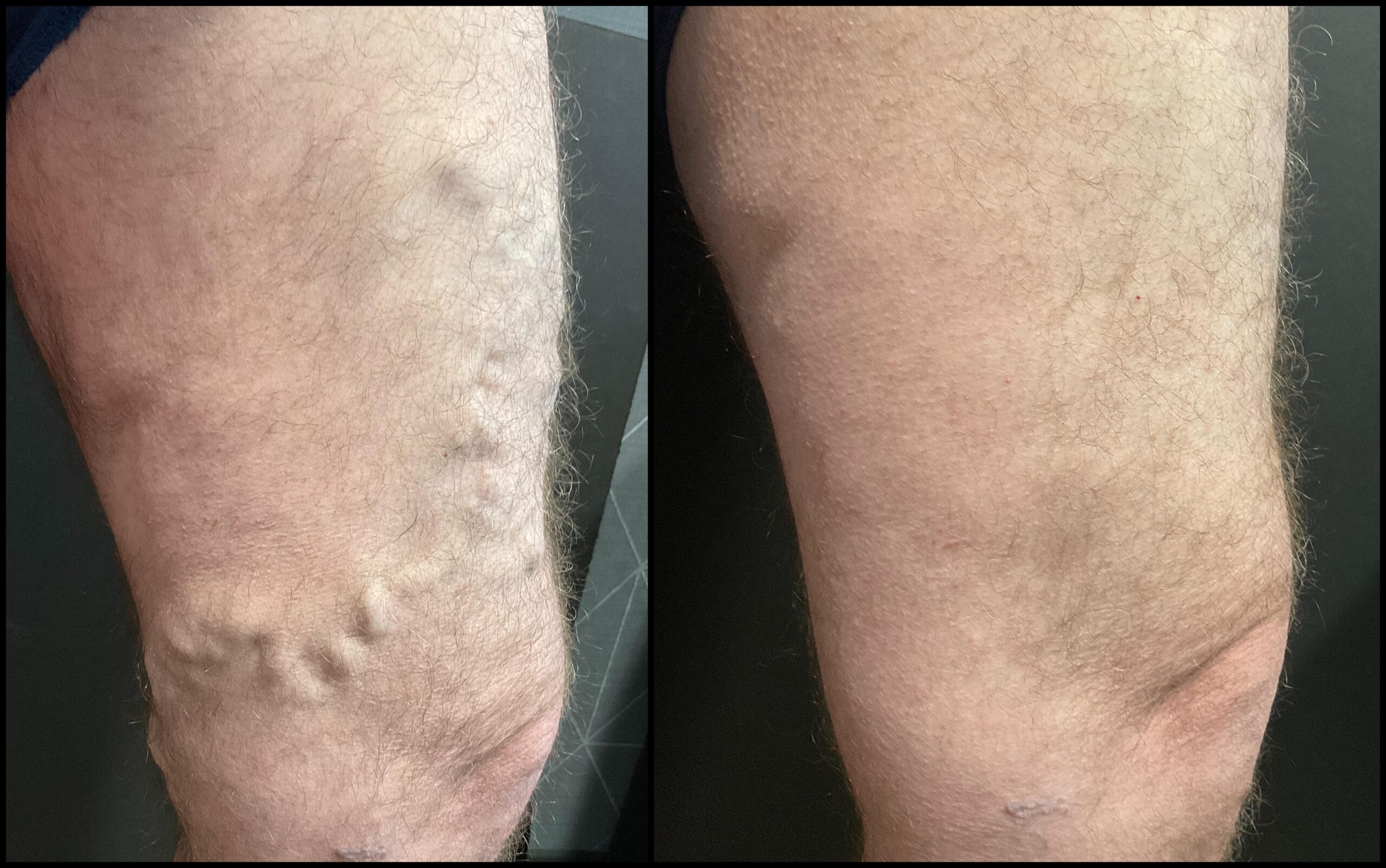 vein treatment before and after image