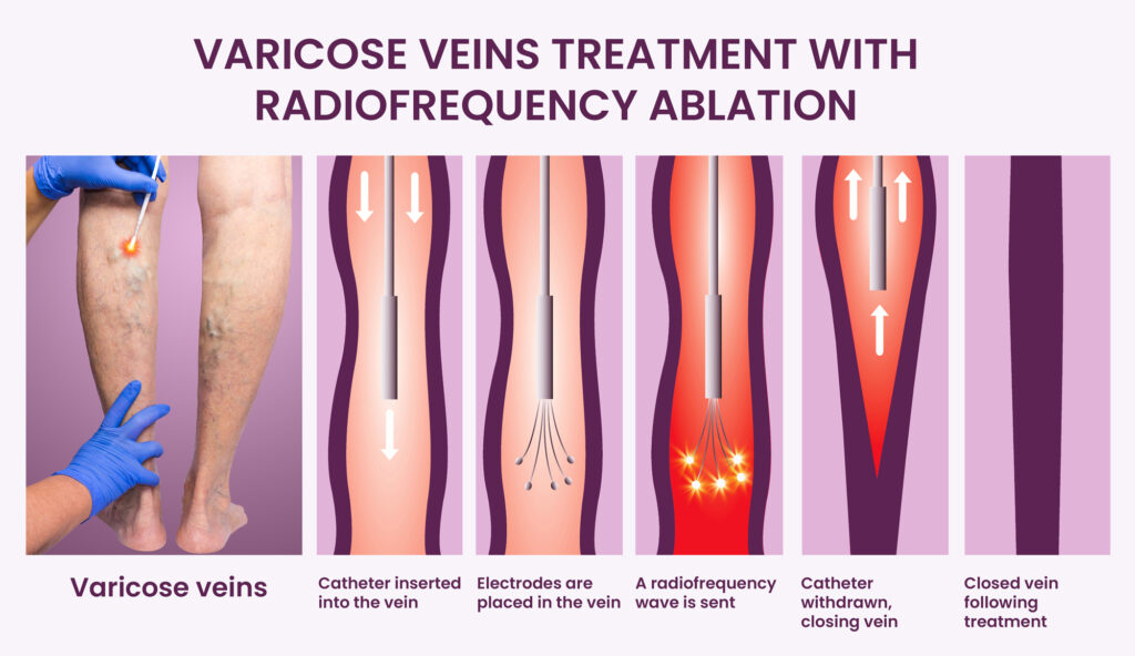 Graphic explaining varicose vein treatment