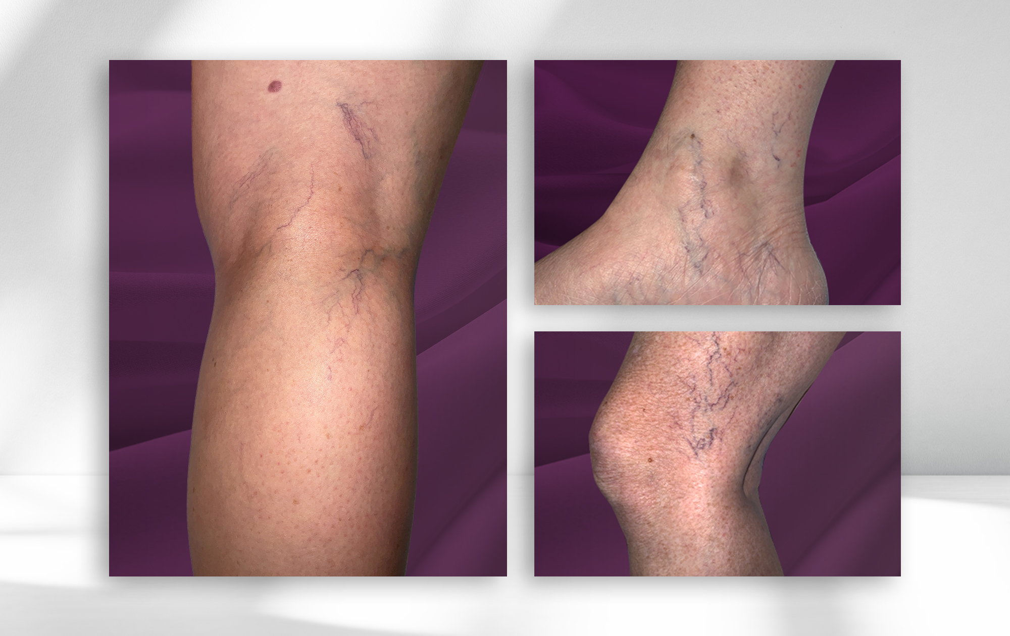 Three images of spider veins appearing on the knee, being the knee, and on the ankle